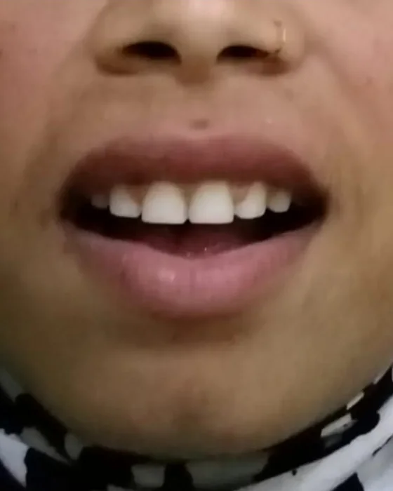 After orthodontic braces treatment at Nirmal Dental Care in Shamli