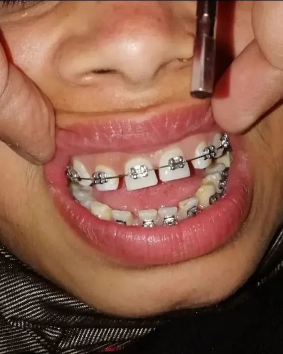 Before orthodontic braces treatment at Nirmal Dental Care in Shamli