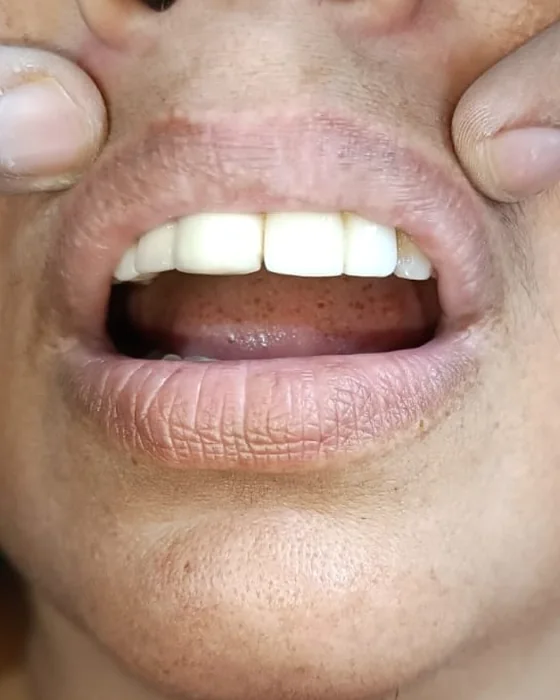 After dental treatment at Nirmal Dental Care in Shamli