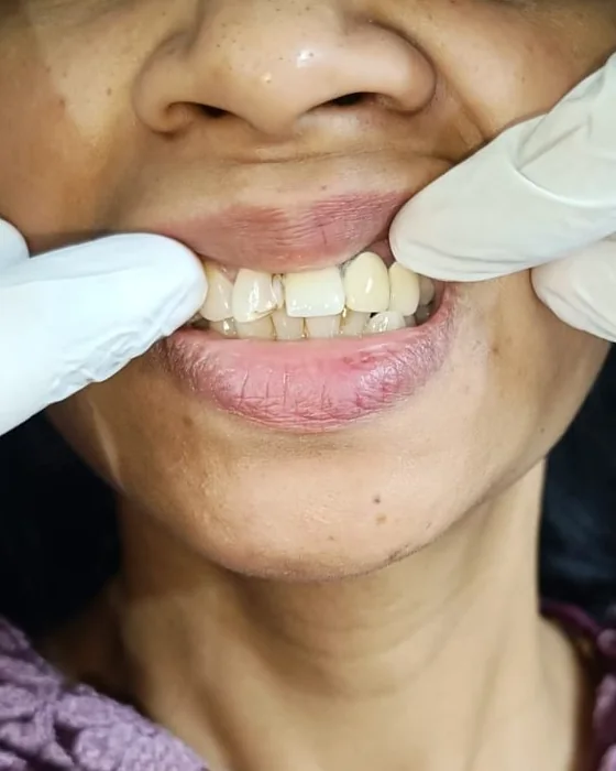 After dental treatment at Nirmal Dental Care in Shamli