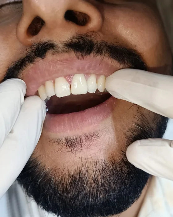 After dental treatment at Nirmal Dental Care in Shamli