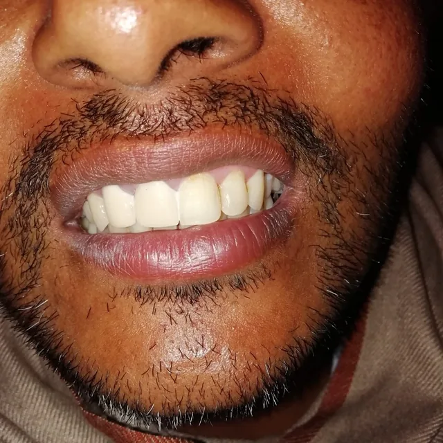 After dental treatment result, case 05 at Nirmal Dental Care in Shamli