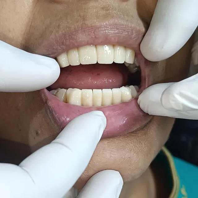 After dental treatment result, case 06 at Nirmal Dental Care in Shamli