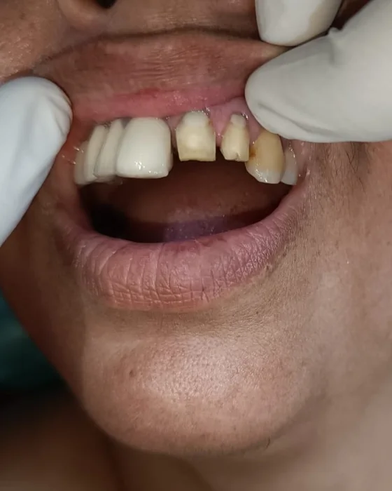 Before dental treatment at Nirmal Dental Care in Shamli