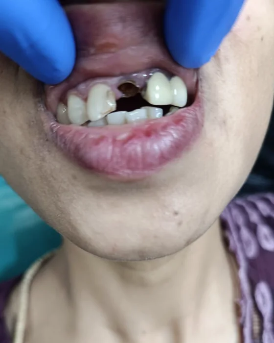 Before dental treatment at Nirmal Dental Care in Shamli