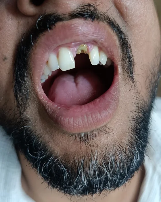Before dental treatment at Nirmal Dental Care in Shamli
