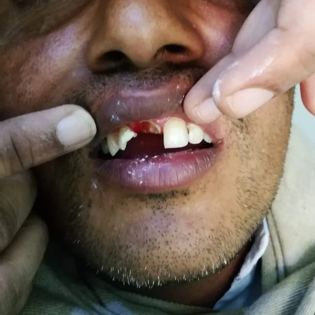 Before dental treatment result, case 05 at Nirmal Dental Care in Shamli