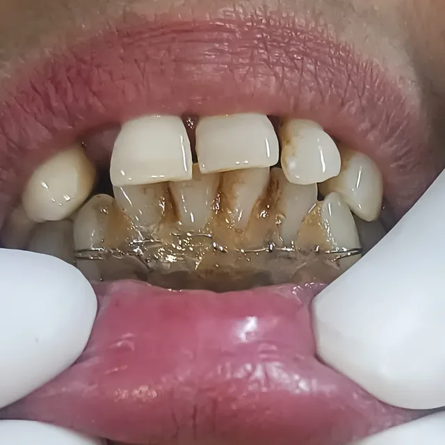 Before dental treatment result, case 06 at Nirmal Dental Care in Shamli